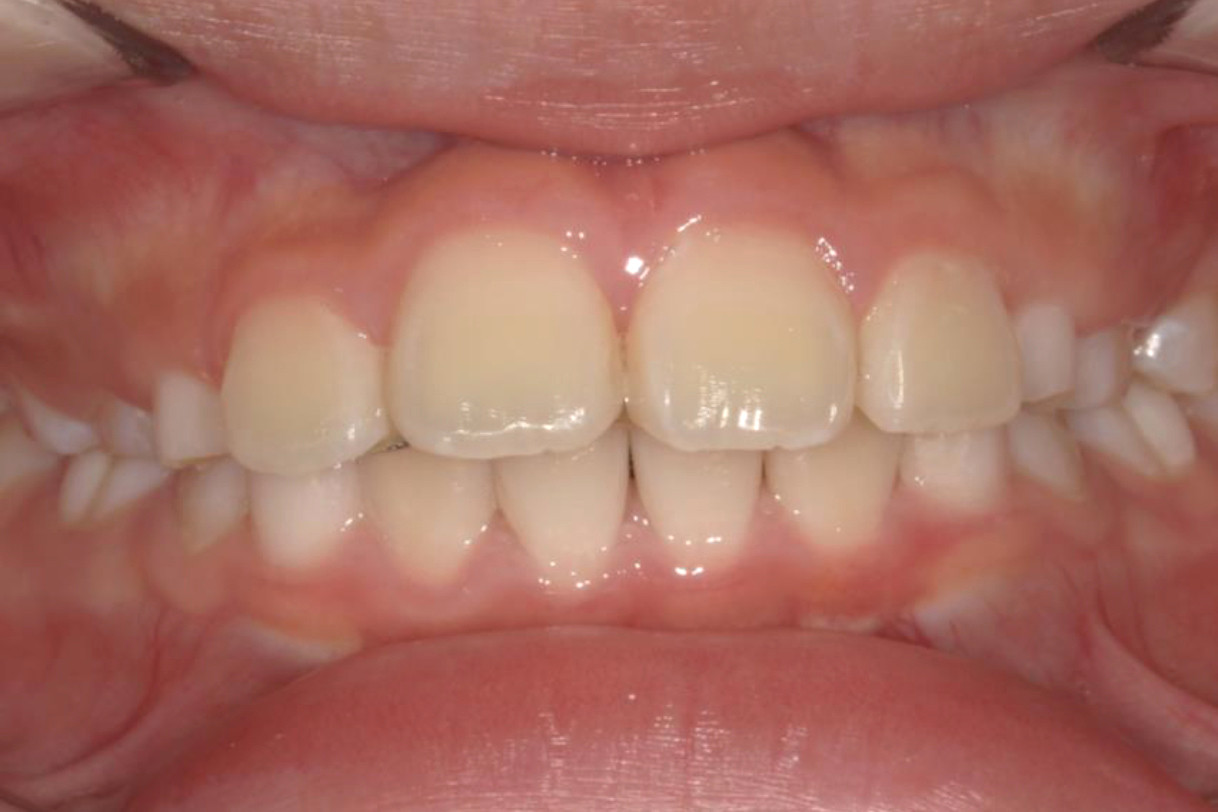 浜松市中区の症例紹介　マウスピース矯正