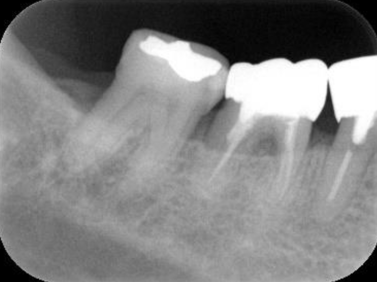 浜松市中区の症例紹介　歯周外科