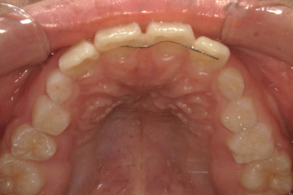 浜松市中区の症例紹介　マウスピース矯正