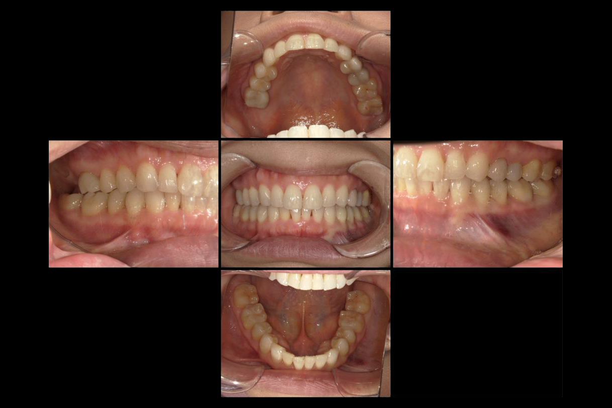 浜松市中区の症例紹介　マウスピース矯正
