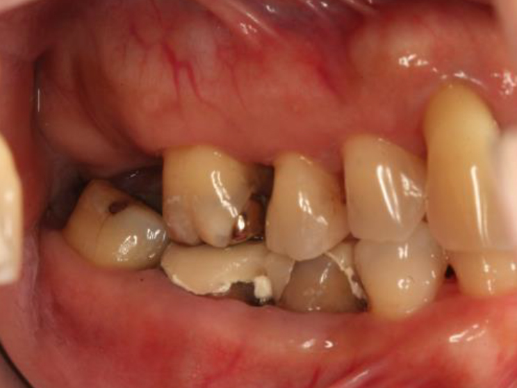 浜松市中区の症例紹介　歯周外科