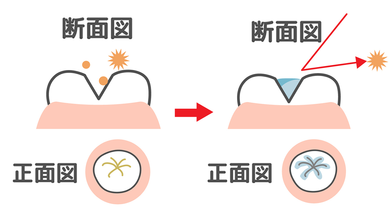 浜松市中区の学校の歯科検診に引っかかった方へ