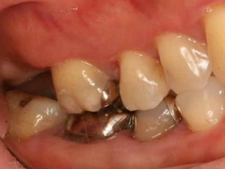 浜松市中区の症例紹介　歯周外科