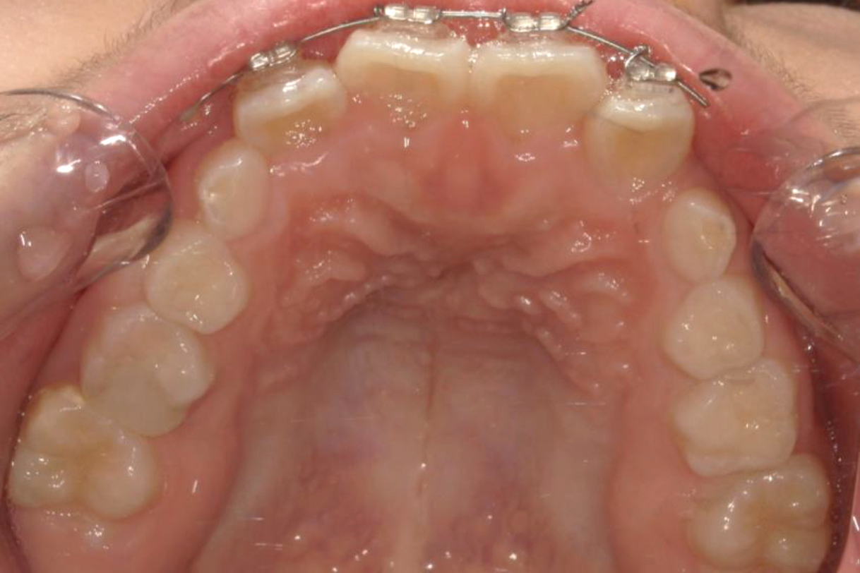 浜松市中区の症例紹介　マウスピース矯正