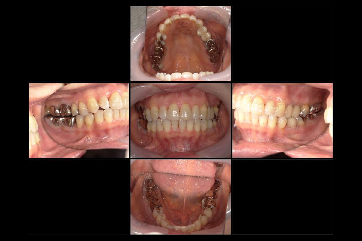 浜松市中区の症例紹介　マウスピース矯正