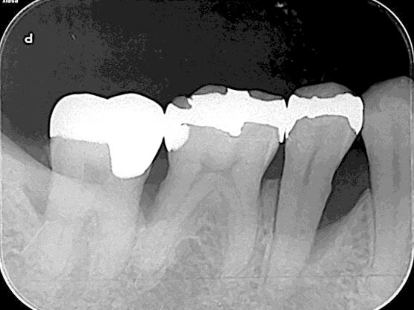浜松市中区の症例紹介　歯周外科