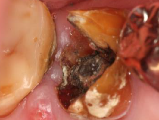 浜松市中区の症例紹介　歯周外科