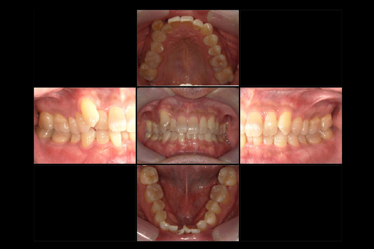 浜松市中区の症例紹介　マウスピース矯正