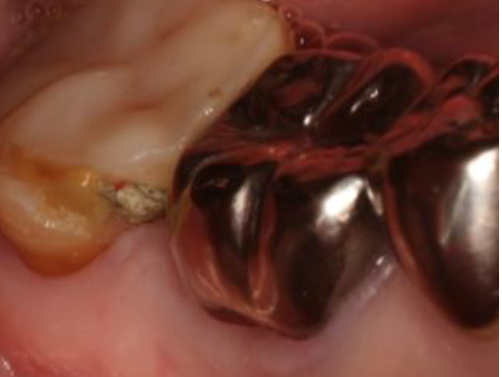 浜松市中区の症例紹介　歯周外科