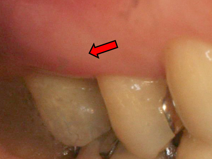 浜松市中区の症例紹介　歯周外科