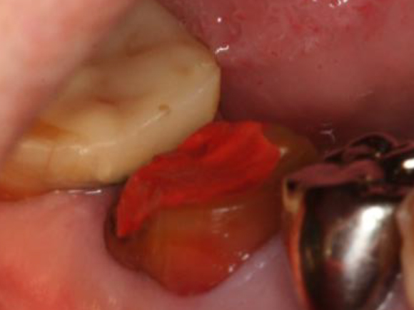 浜松市中区の症例紹介　歯周外科