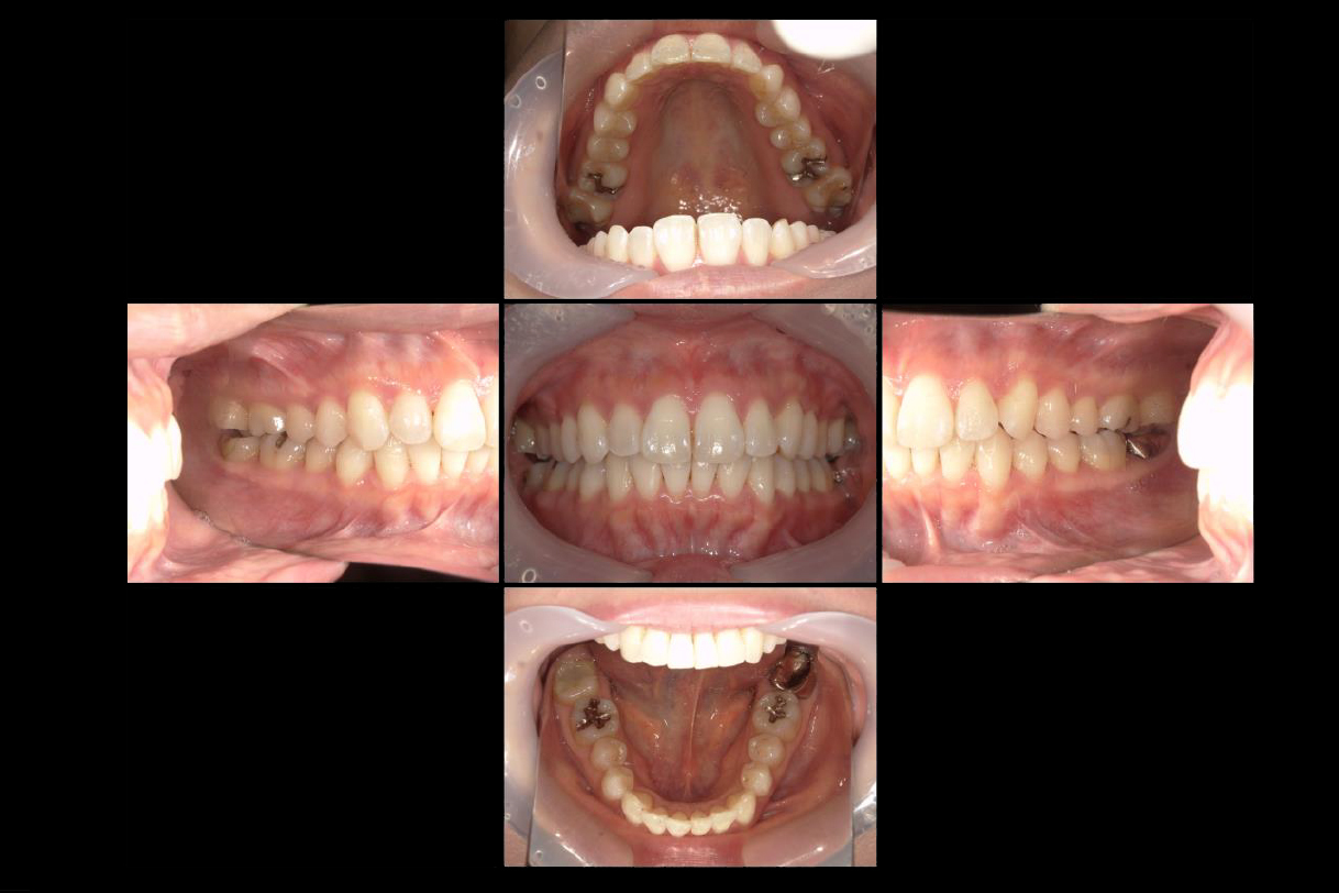 浜松市中区の症例紹介　マウスピース矯正