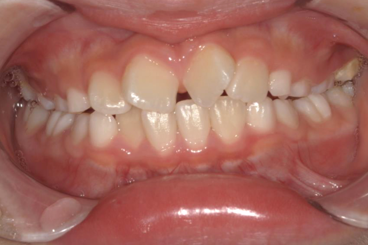 浜松市中区の症例紹介　マウスピース矯正