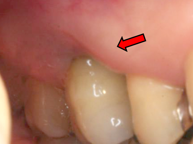 浜松市中区の症例紹介　歯周外科