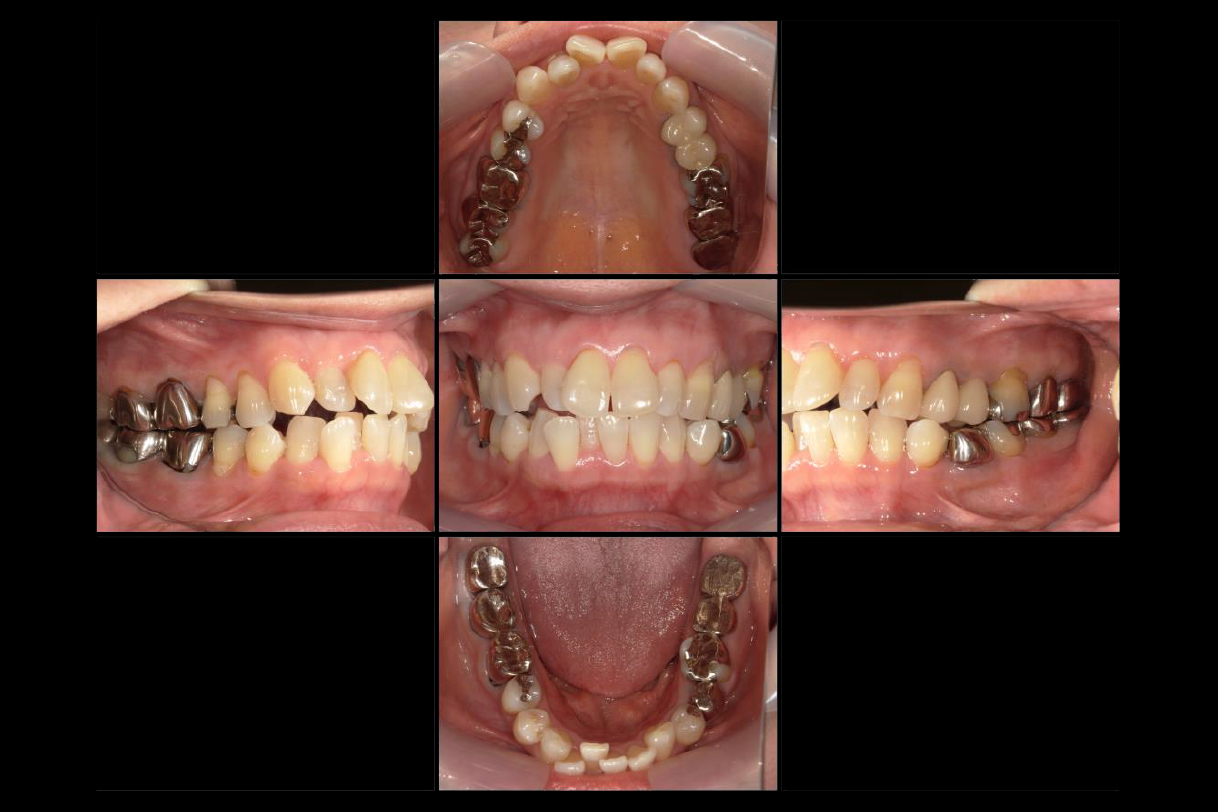 浜松市中区の症例紹介　マウスピース矯正