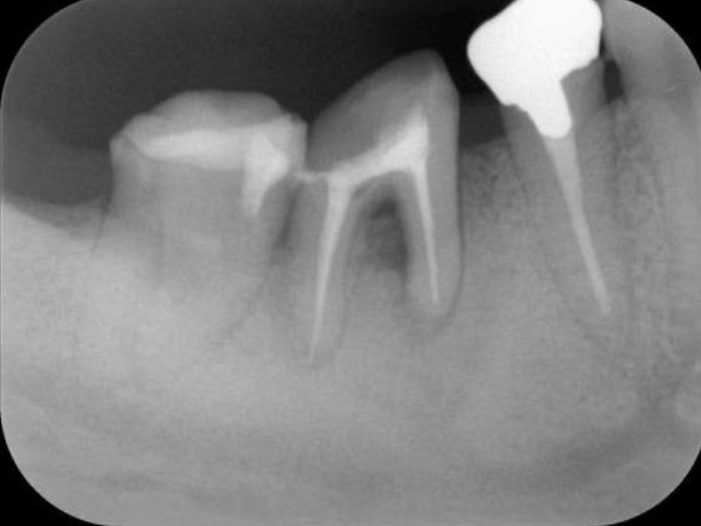 浜松市中区の症例紹介　歯周外科