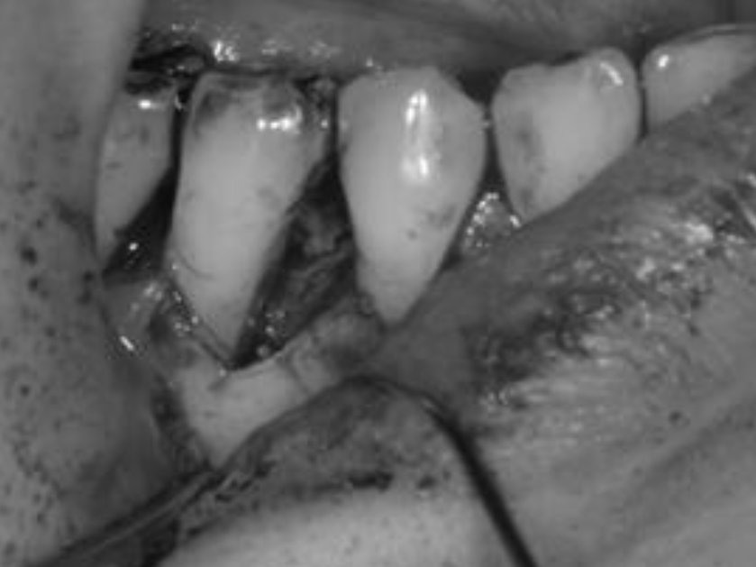 浜松市中区の症例紹介　歯周外科