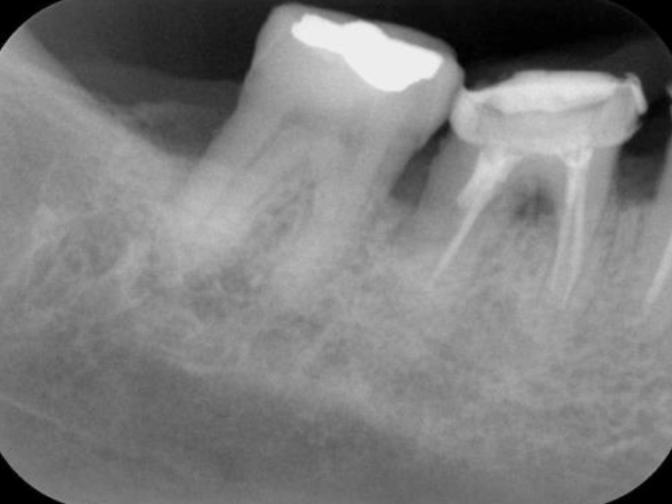 浜松市中区の症例紹介　歯周外科