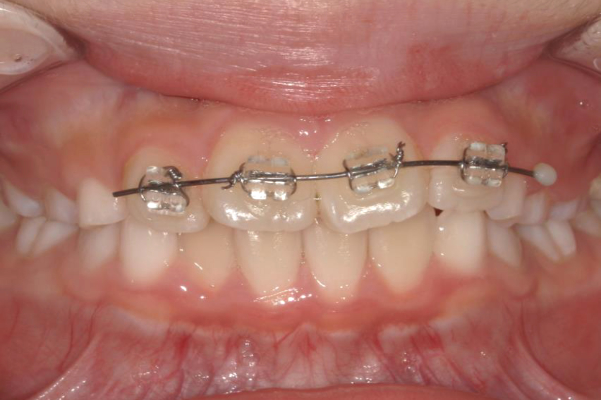 浜松市中区の症例紹介　マウスピース矯正