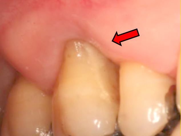 浜松市中区の症例紹介　歯周外科