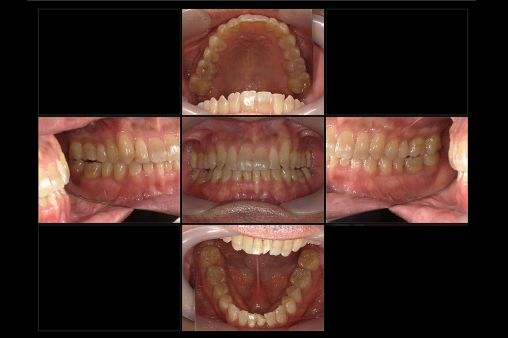 浜松市中区の症例紹介　マウスピース矯正