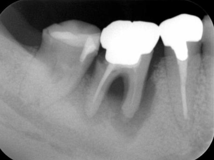 浜松市中区の症例紹介　歯周外科