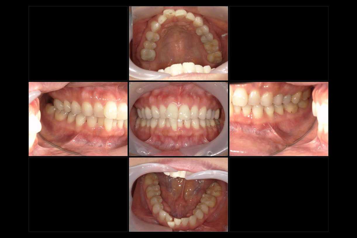 浜松市中区の症例紹介　マウスピース矯正