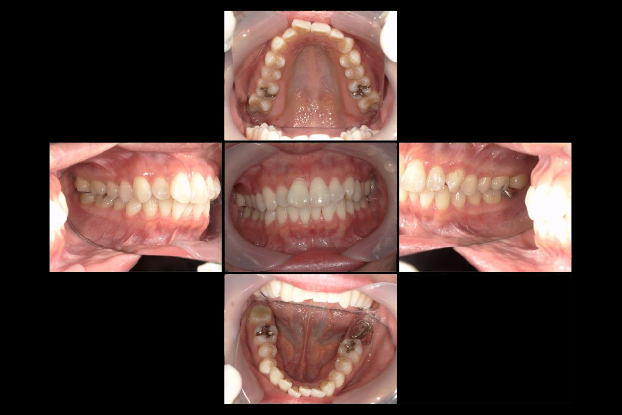 浜松市中区の症例紹介　マウスピース矯正