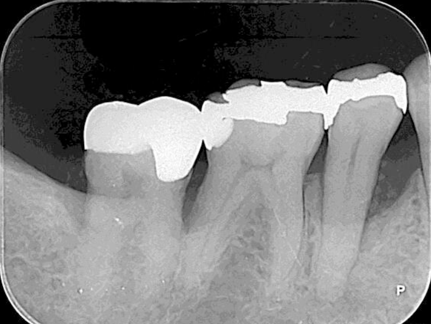 浜松市中区の症例紹介　歯周外科