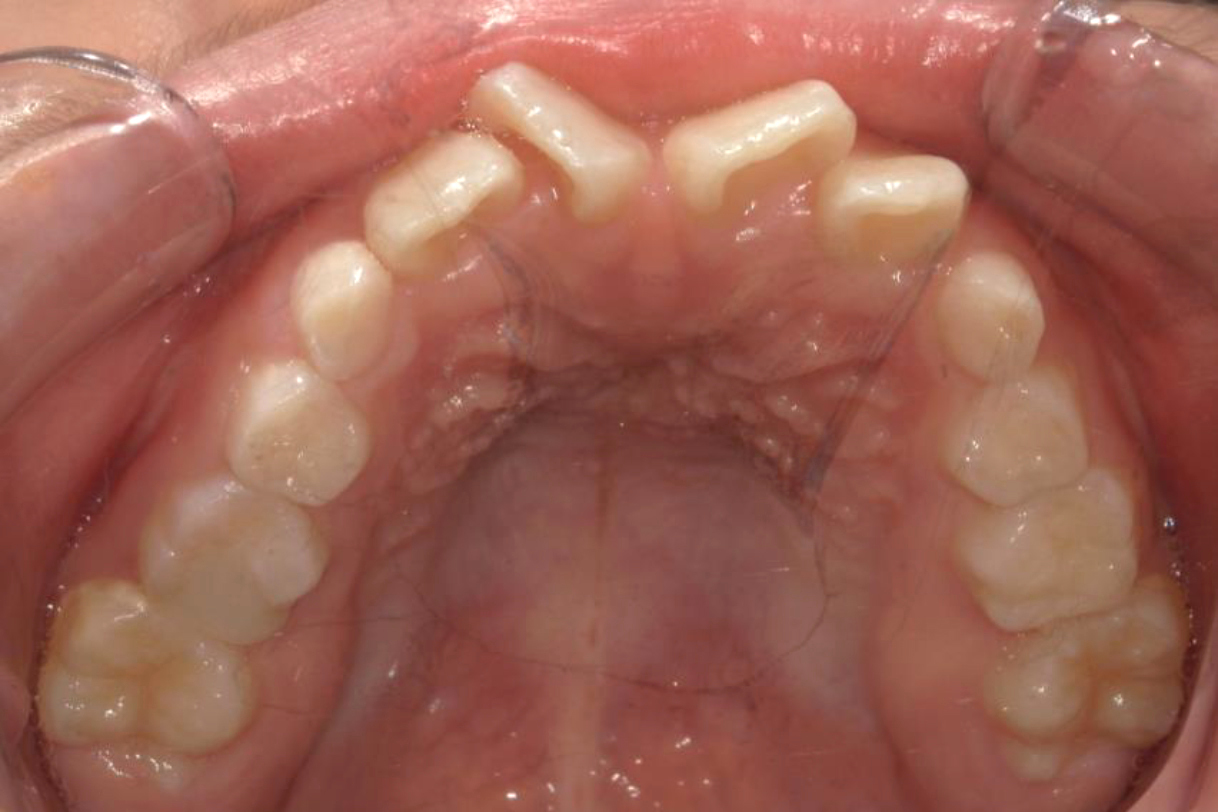 浜松市中区の症例紹介　マウスピース矯正