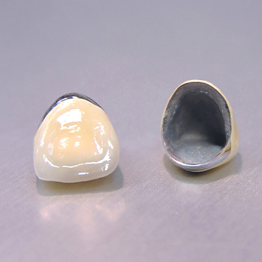 浜松市中区のセラミック治療