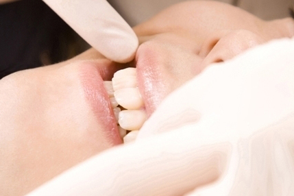 浜松市中区のセラミック治療