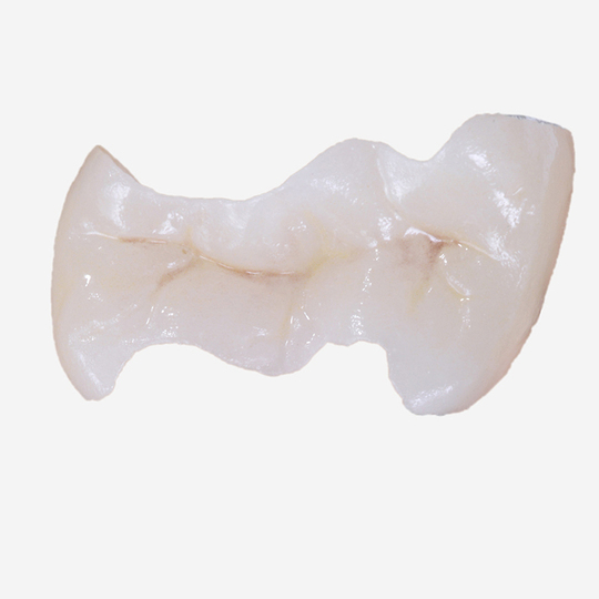 浜松市中区のセラミック治療